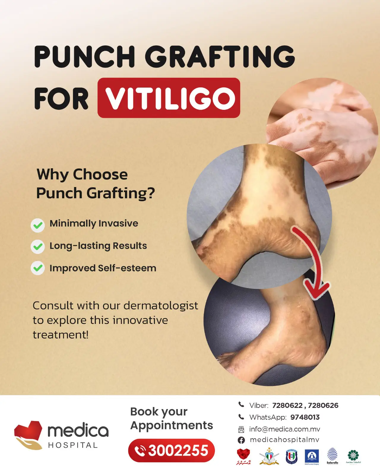 punch crafting for vitiligo